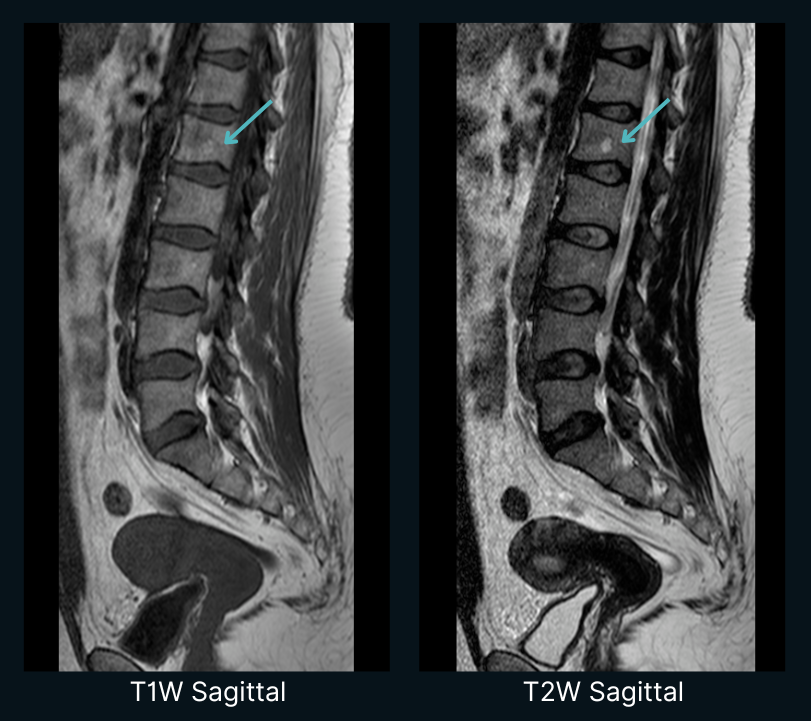 What Claude Opus found (a spinal lesion) by reasoning from clinical knowledge alone.